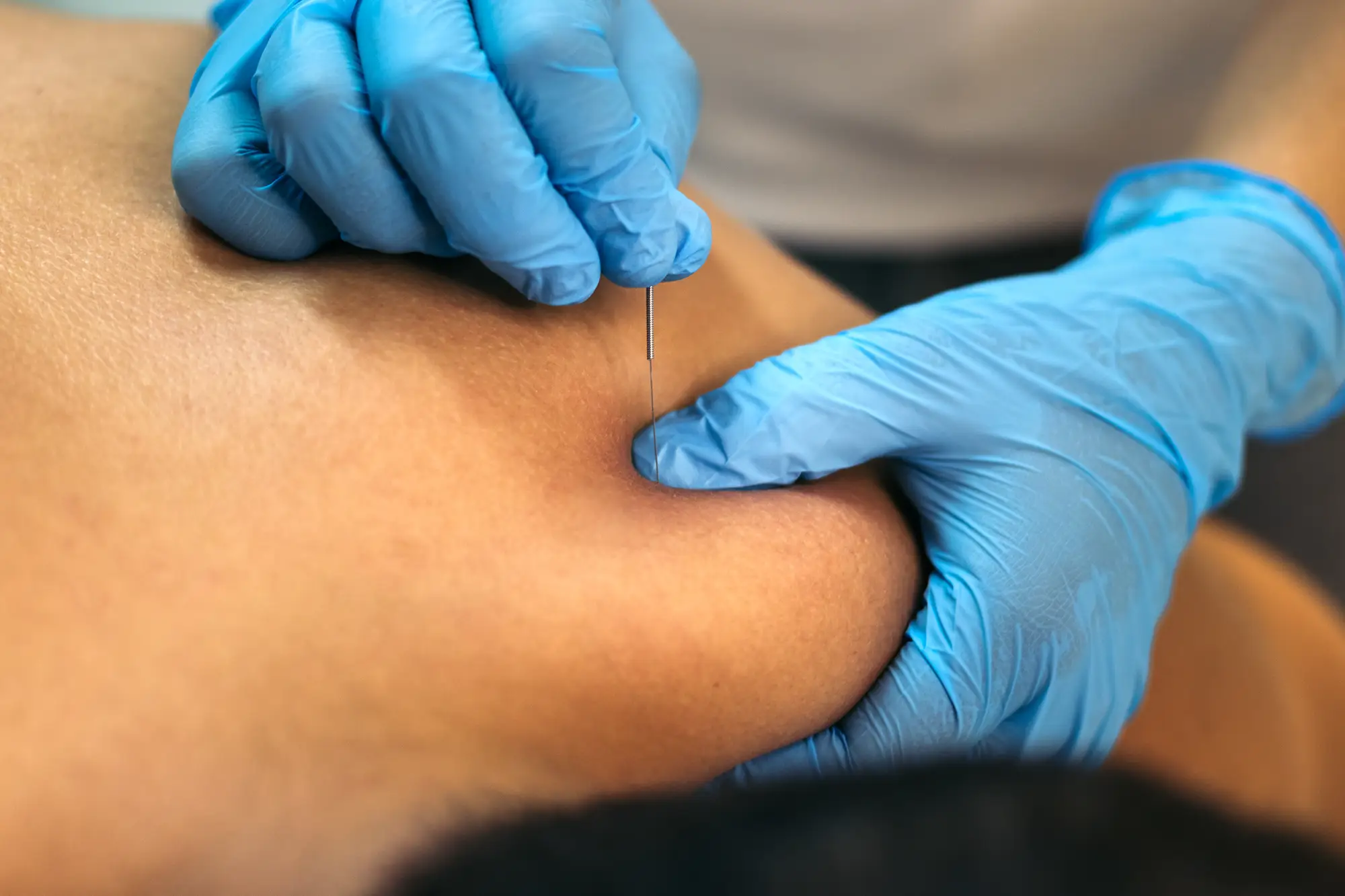 dry-needling